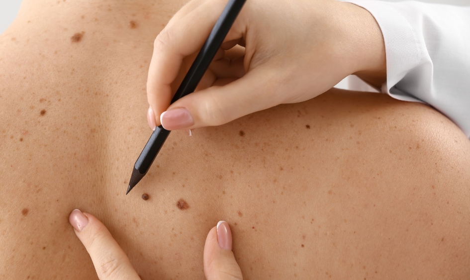 skin cancer